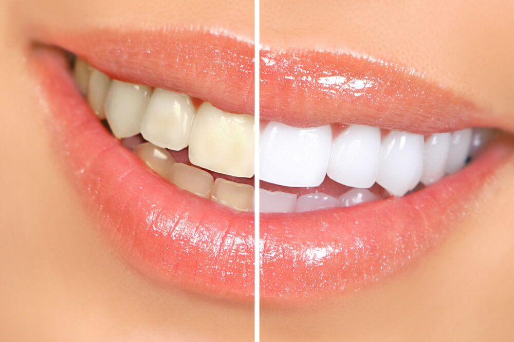 Zoom teeth whitening treatment results