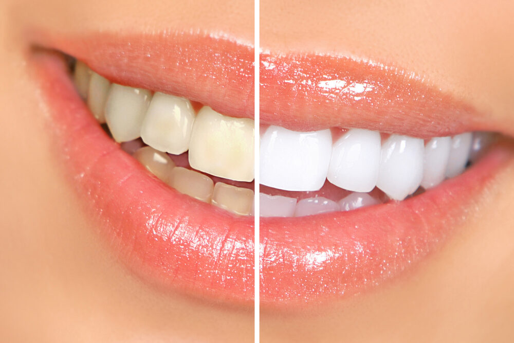 Zoom Teeth Whitening, Cosmetic Dentistry in Mona Vale