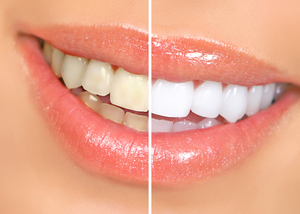 Teeth Whitening Before and After, Zoom Whitening, Philips Zoom Teeth Whitening, best teeth Whitening System, Park St Dental Practice, Dr Neda Gorji and Associates, Mona Vale Dental Implant Centre, Best Cosmetic Dentist Near Me, Park St Dental Practice, Mona Vale Dentist, Dr Neda Gorji and Associates, Mona Vale Best Cosmetic Dentist, Best Dentist in Mona Vale, Straight teeth, Northern Beaches Cosmetic Dentist, Smile Makeover, porcelain Veneers, Smile Design in Mona Vale
