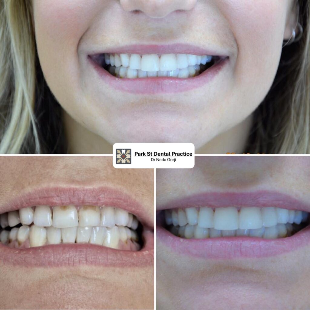 Teeth Veneers before and after results, Teeth Veneers before and after smile transformation, Best veneers in Sydney, Best Veneers in Northern Beaches, Best Cosmetic Dentist Near Me, Park St Dental Practice, Mona Vale Dentist, Dr Neda Gorji and associates, Mona Vale Best Dental Practice, Dr Neda Gorji & Associates, Mona Vale Best Cosmetic Dentist, Crown, Straight teeth, Northern Beaches Cosmetic Dentist, Smile Makeover, porcelain veneers, smile Design in Mona Vale