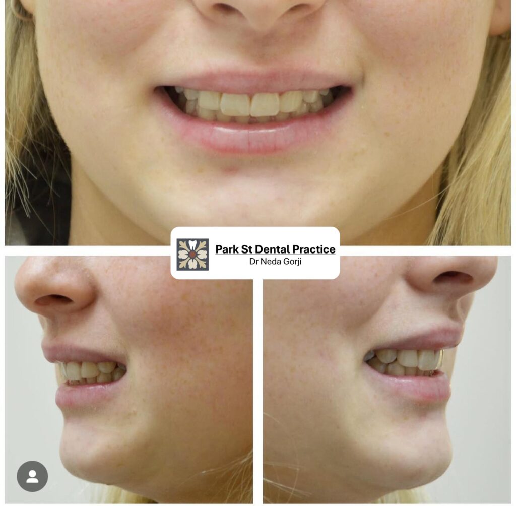 Veneers in Mona Vale, Veneers in Northern Beaches, Teeth Veneers before and after smile transformation, Best veneers in Sydney, Best Veneers in Northern Beaches, Best Cosmetic Dentist Near Me, Park St Dental Practice, Mona Vale Dentist, Dr Neda Gorji and associates, Mona Vale Best Dental Practice, Dr Neda Gorji & Associates, Mona Vale Best Cosmetic Dentist, Crown, Straight teeth, Northern Beaches Cosmetic Dentist, Smile Makeover, porcelain veneers, smile Design in Mona Vale