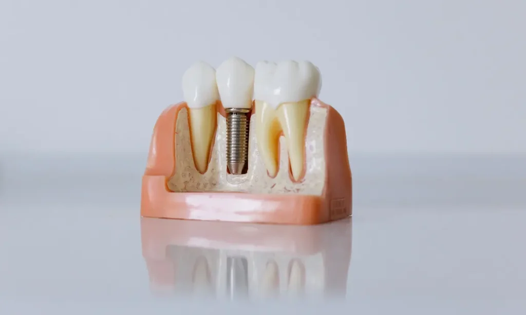 Does Food Get Stuck Under All-on-4 Dental Implants