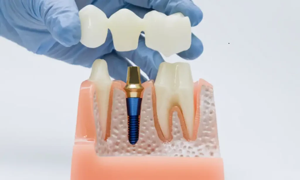 what are screwless dental implants