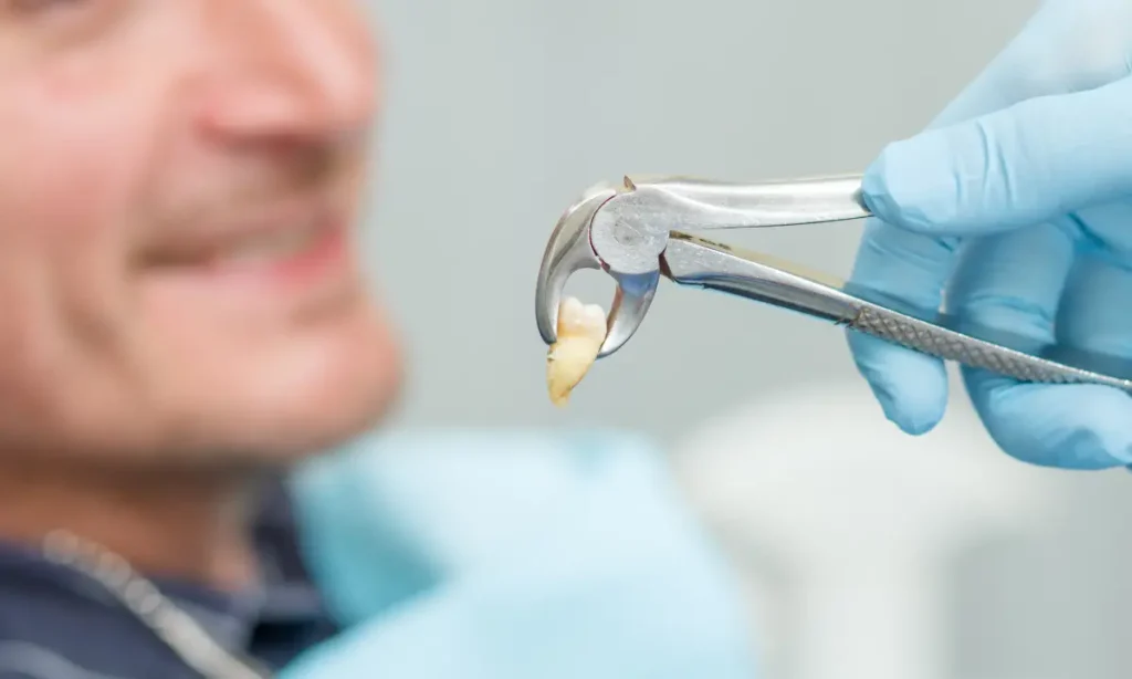 How Long Does a Tooth Extraction Take to Heal
