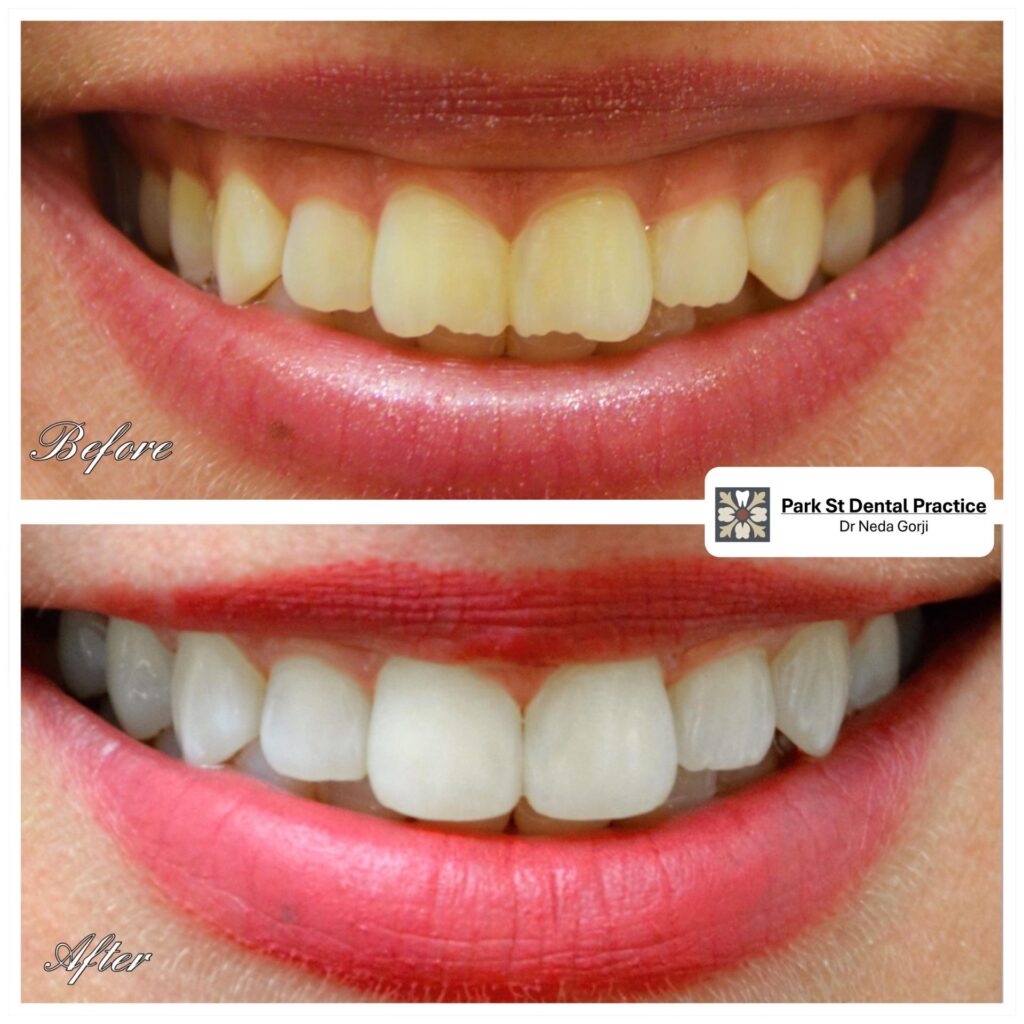 Teeth Composite Veneers before and after smile transformation,Best veneers in Sydney, Best Veneers in Northern Beaches, Best Cosmetic Dentist Near Me, Park St Dental Practice, Mona Vale Dentist, Dr Neda Gorji and Associatesntal Practice, Dr Neda Gorji & Associates, Mona Vale Best Cosmetic Dentist, Crown, Straight teeth, Northern Beaches Cosmetic Dentist, Smile Makeover, porcelain veneers, smile Design in Mona Vale