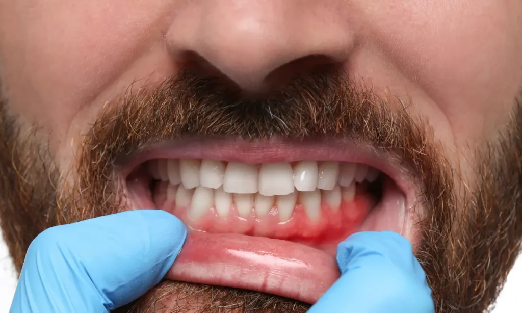 Tooth Abscess Symptoms