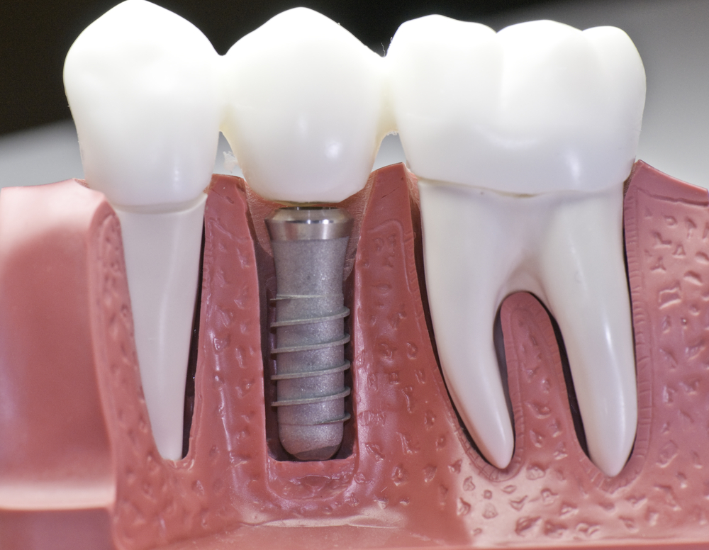 Dental implant treatment at Park St Dental Practice Mona Vale, Park St Dental Practice, Sydney Northern Beaches, Mona Vale, Dr Neda Gorji, Best Implant Dentist, Mona Vale Dental Implant Centre, Tooth Implant, Implant Denture