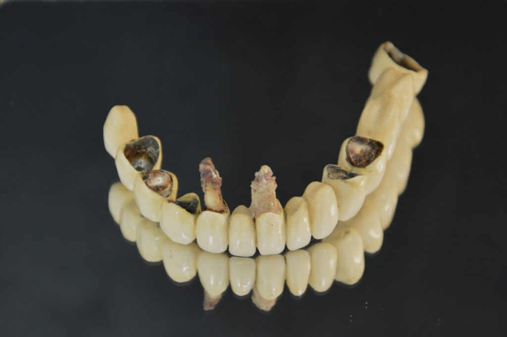 A Dental Implant Story from Park St Dental Practice in Mona Vale
