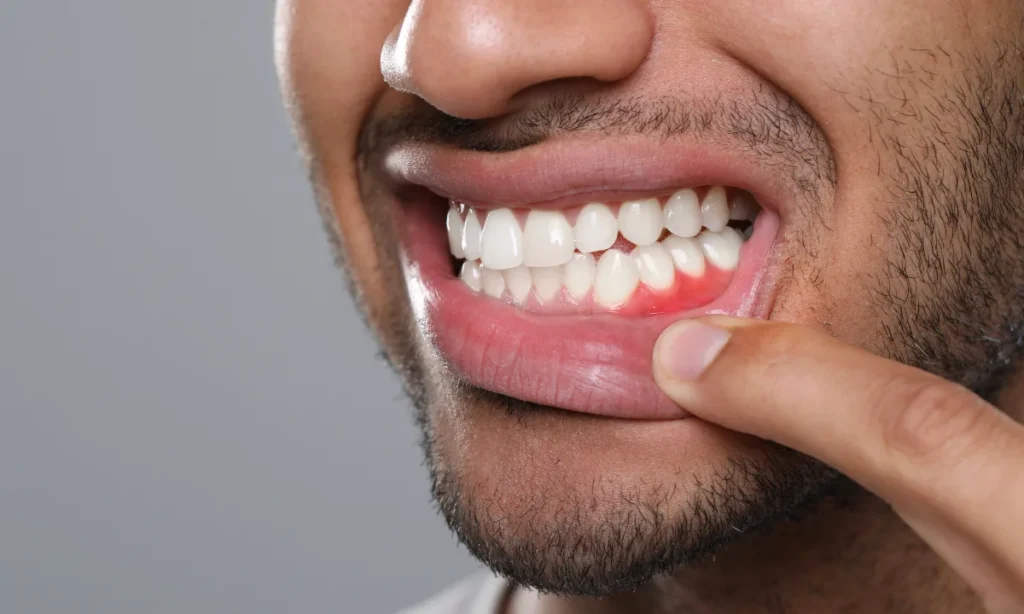 Stages of Gum Disease: Signs, Progression and Treatment