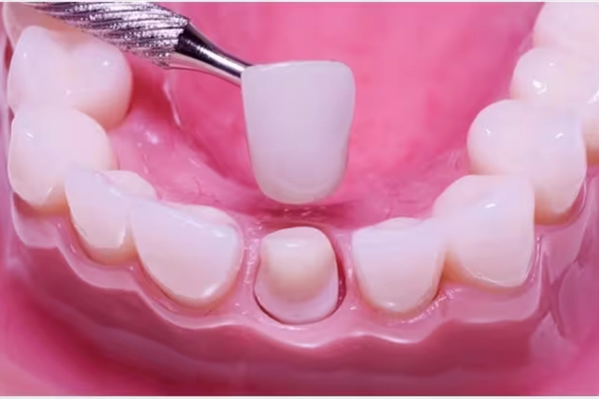 Dental Crown, Tooth crown, Best Dentist for Crown and bridge, Best veneers in Sydney, Best Veneers in Northern Beaches, Best Cosmetic Dentist Near Me, Park St Dental Practice, Mona Vale Dentist, Dr Neda Gorji and Associates, Mona Vale Best Cosmetic Dentist, Crown, Straight teeth, Northern Beaches Cosmetic Dentist, Smile Makeover, porcelain veneers