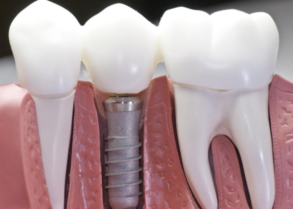 Dental Implants before and after smile transformation, before and After Tooth Implants, Park St Dental Practice, Dr Neda Gorji, Mona Vale Best Cosmetic Dentist, Mona vale Dental Implant Centre, Smile Makeover, Northern Beaches Best Dentist, Best Implant Dentist, Northern Beaches Dental Implants, Mona vale Dental Implants, Implant Dentist, Lost tooth, Smile Design, Mona Vale Smile makeover, Sydney Best Dental Implants, Tooth Implants, Broken Tooth, Lost Front Tooth, Implant in One Day on Northern beaches, Sydney Cosmetic Dental Implants Dental Implants before and after smile transformation, before and After Tooth Implants, Park St Dental Practice, Dr Neda Gorji, Mona Vale Best Cosmetic Dentist, Mona vale Dental Implant Centre, Smile Makeover, Northern Beaches Best Dentist, Best Implant Dentist, Northern Beaches Dental Implants, Mona vale Dental Implants, Implant Dentist, Lost tooth, Smile Design, Mona Vale Smile makeover, Sydney Best Dental Implants, Tooth Implants, Broken Tooth, Lost Front Tooth, Implant in One Day on Northern beaches, Sydney Cosmetic Dental Implants